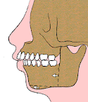 Mandibular Retrognathia