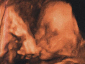 Bon OK, c'est pas très beau à voir : les déformations sont dûes au placenta (Poids : 850 grammes). Bon OK, c'est pas très beau à voir : les déformations sont dûes au placenta (Poids : 850 grammes).
