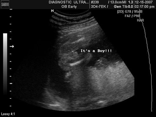 3d ultrasound 20 weeks boy. I had a 3d ultrasound.