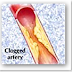 Angioplasty's Heyday May Be Over