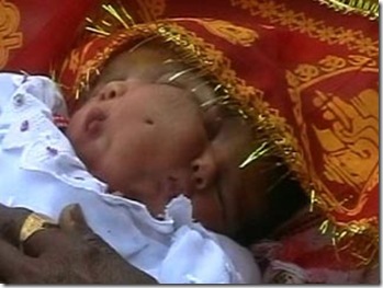 Photo of Indian Baby Girl Born With Two Faces