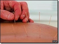 Acupuncture best for back pain